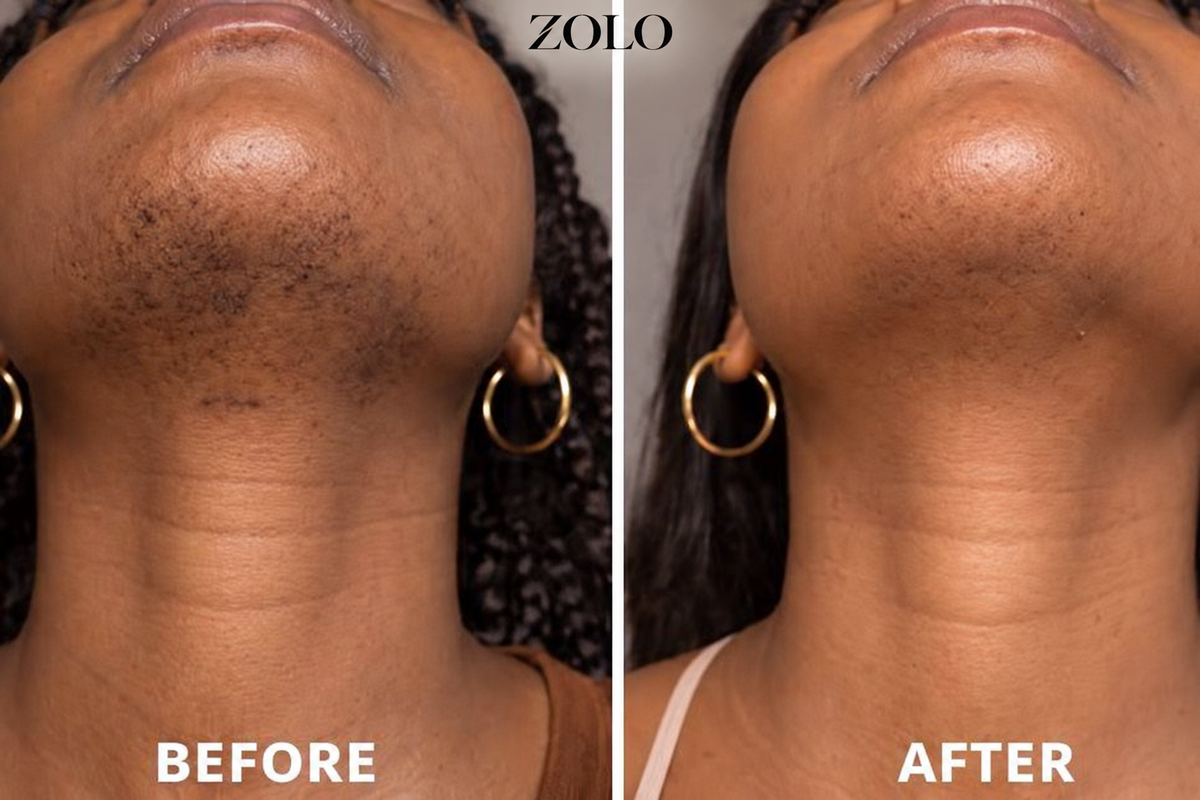 Zolo Facial Hair Removal Cream