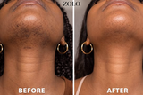 Zolo Facial Hair Removal Cream