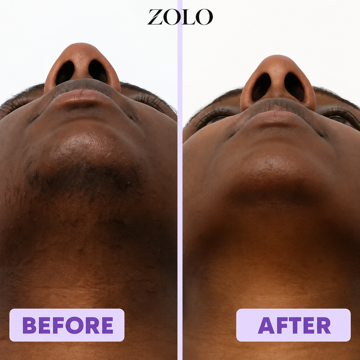 Zolo Facial Hair Removal Cream