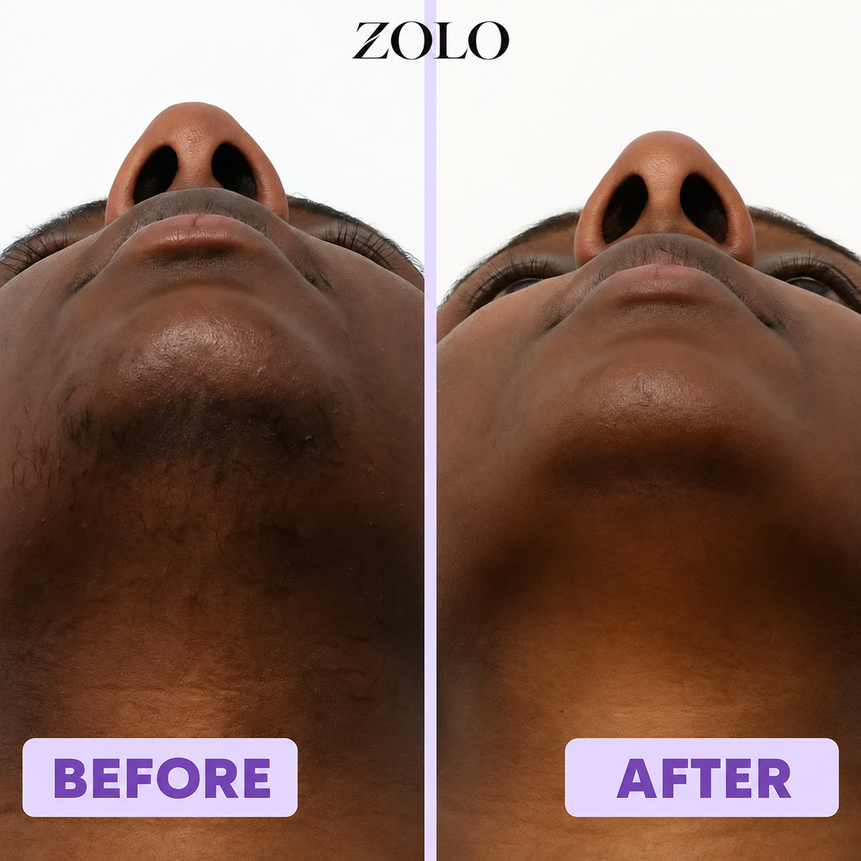 Before and after result